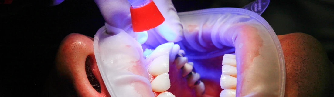 Close-Up Of A Dental Curing Light Being Used During A Cosmetic Dental Procedure