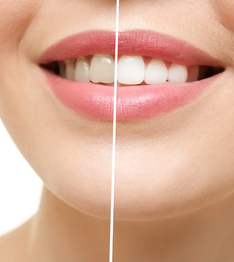 Before-And-After Teeth Whitening Comparison